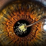 Terobosan Penelitian! Suntikan Partikel Emas Bisa Pulihkan Penglihatan Tanpa Operasi